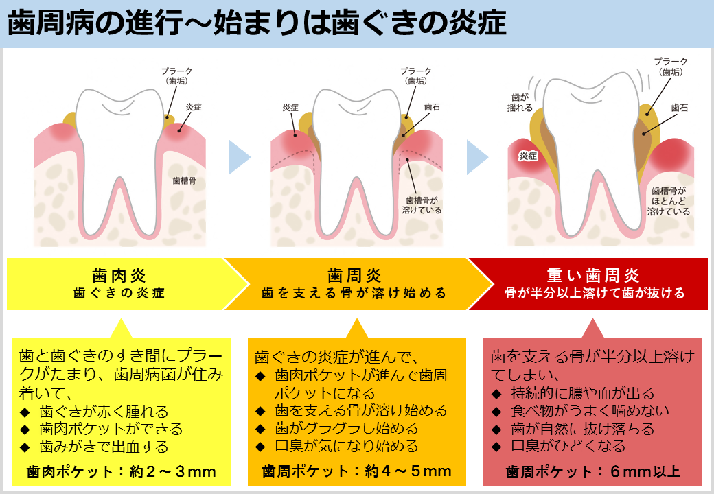 歯周病は歯肉炎から始まり、歯周炎、重い歯周炎と進行していく。