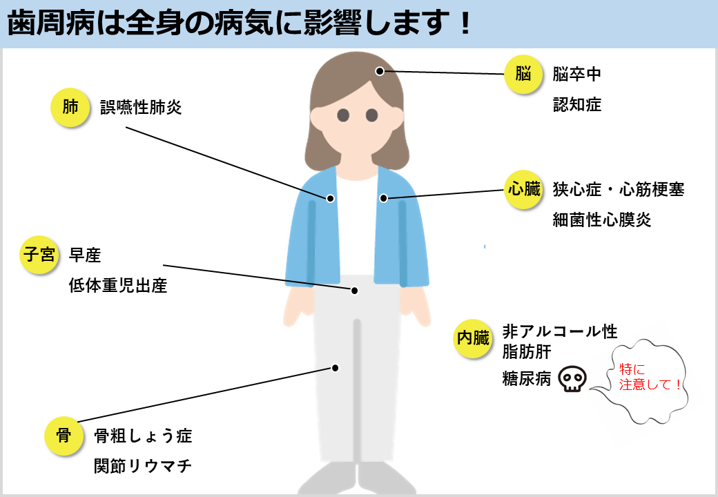 歯周病は全身の病気に影響する