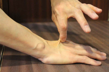 皮膚のつまみ上げ